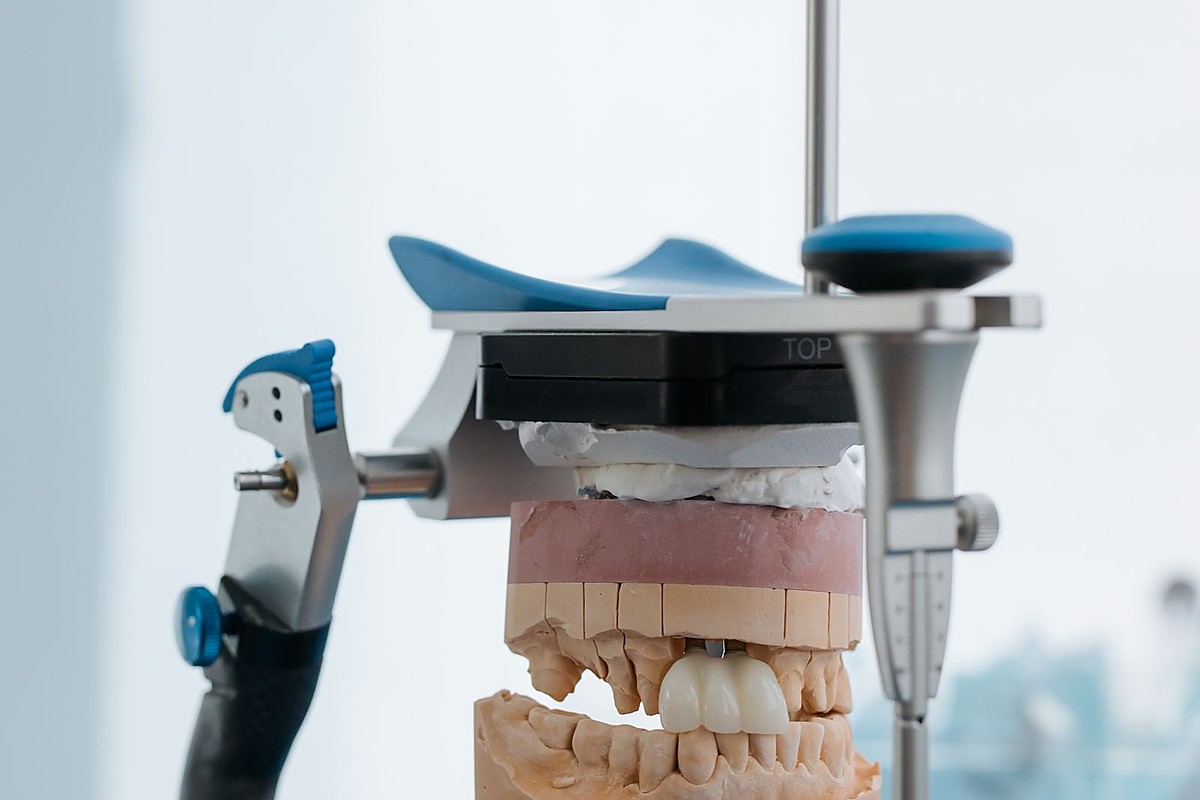 Dental crowns and bridges to restore damaged teeth at Dental Dew Rohini