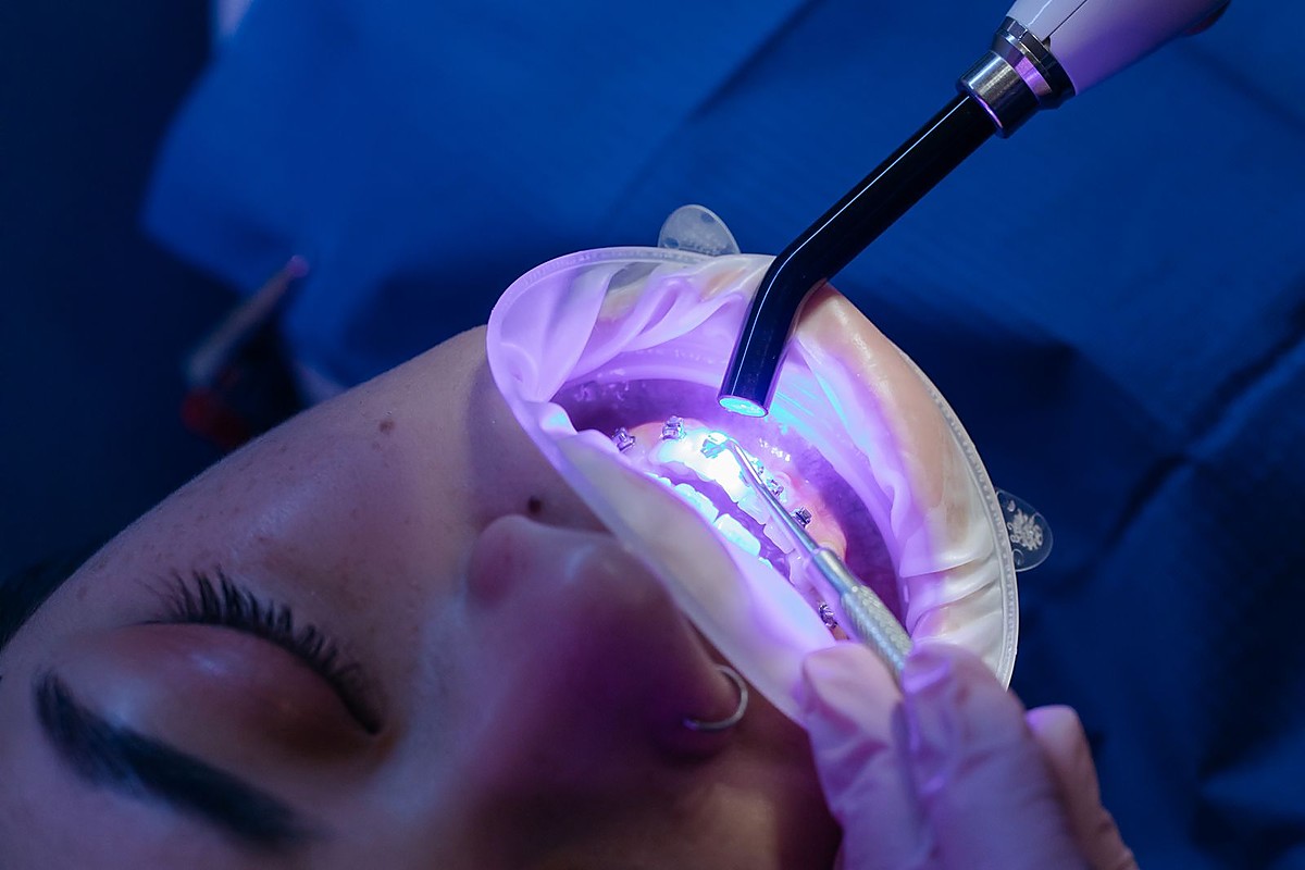 Dental filling to restore a decayed tooth at Dental Dew Clinic Rohini